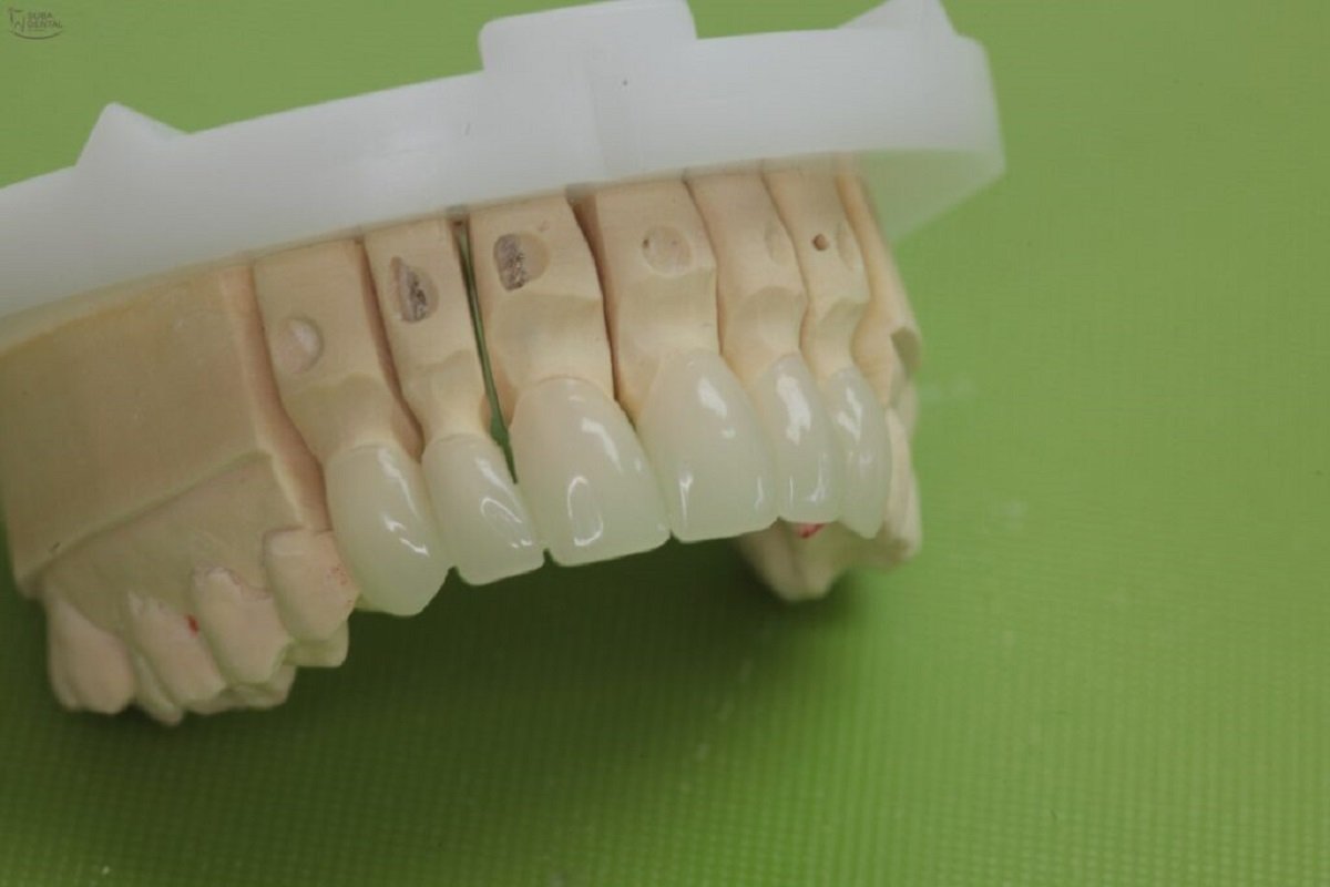 PMMA Temporary Crown