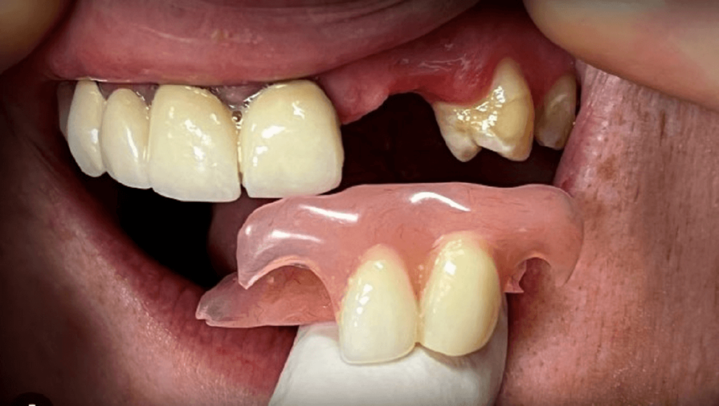 Partial Dentures for Back Teeth
