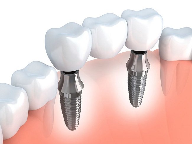 Perfect dental implant color match