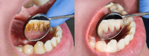 Periodontal Maintenance Cleaning