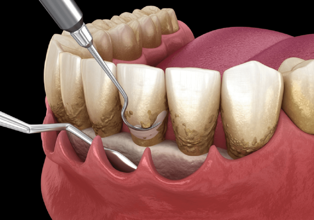Periodontal procedure in progress
