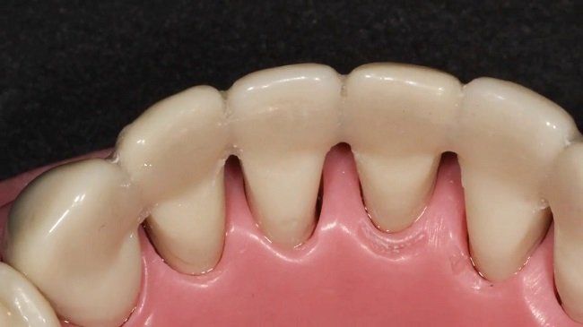 Periodontal splints