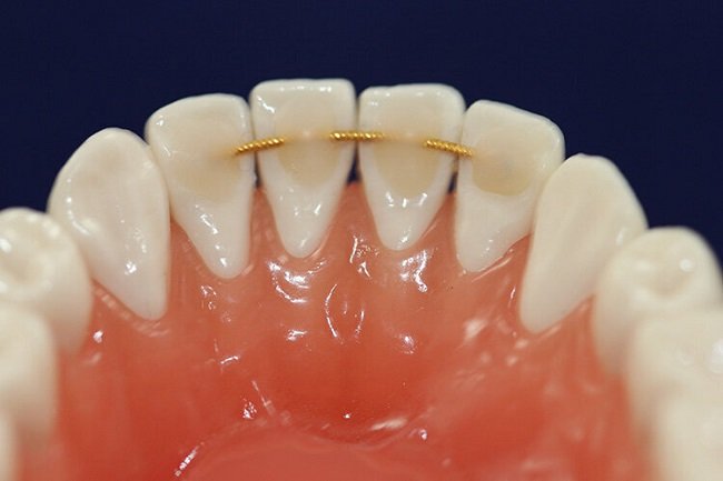 Permanent (Bonded) Retainers