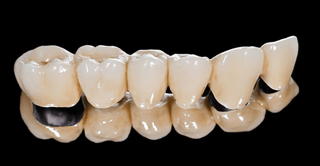Pfm Dental Bridge