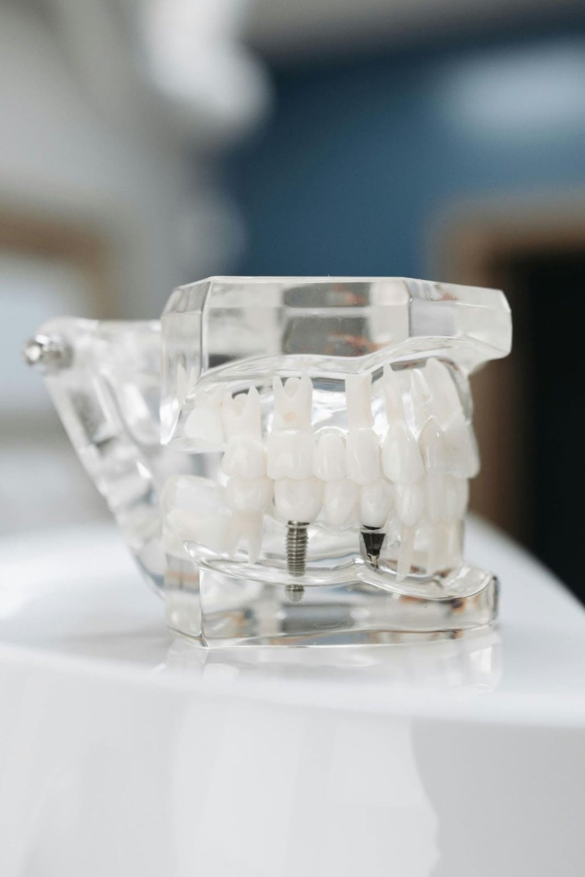 Photo of a crown that has undergone zirconia restoration placed on a surface.