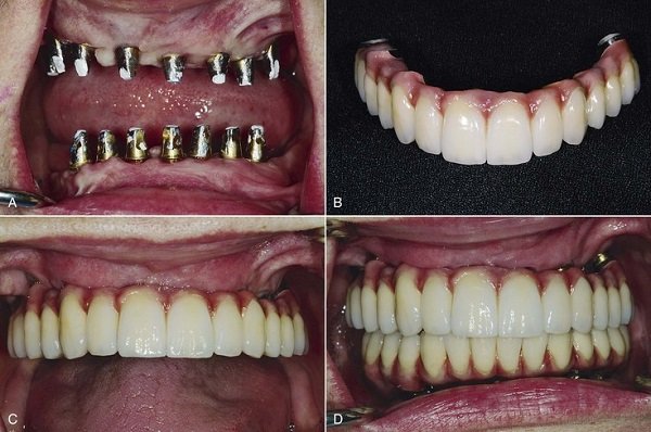 Place Final Prosthetic