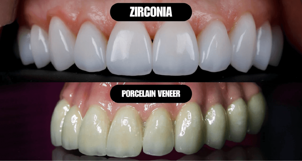Porcelain vs Zirconia Veneers