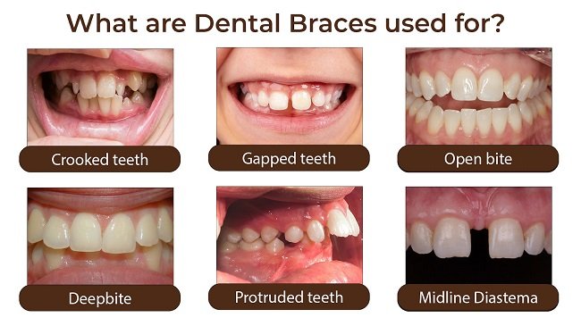 Problems that solve Metal Dental Braces