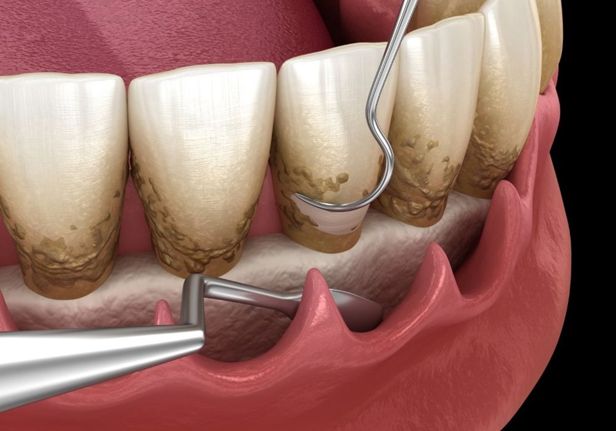 Process of periodontal treatment for removing plaque from teeth and gums