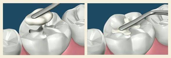 Putting a stronger dental feeling