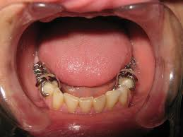 Removable Partial Dentures