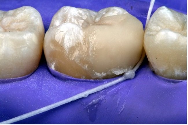 Removing resin from inside a crown