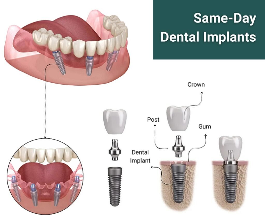 Same Day Dental Implants process