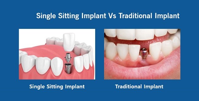 Same Day Dental Implants vs Traditional Implants