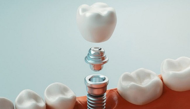 Screw-Retained Prostheses
