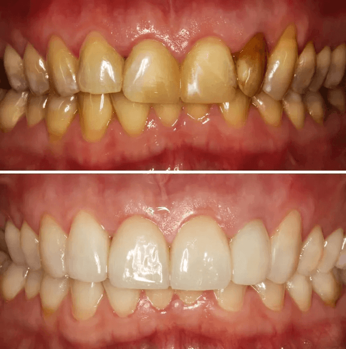 Side Effects of Stannous Fluoride Dental Gel