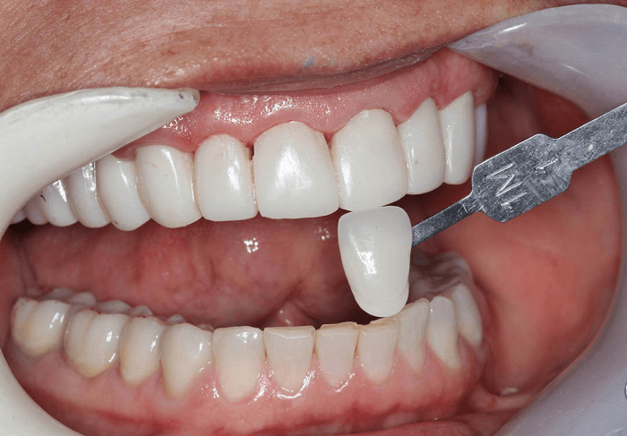 Side-by-side differentiation between natural or porcelain denture tooth