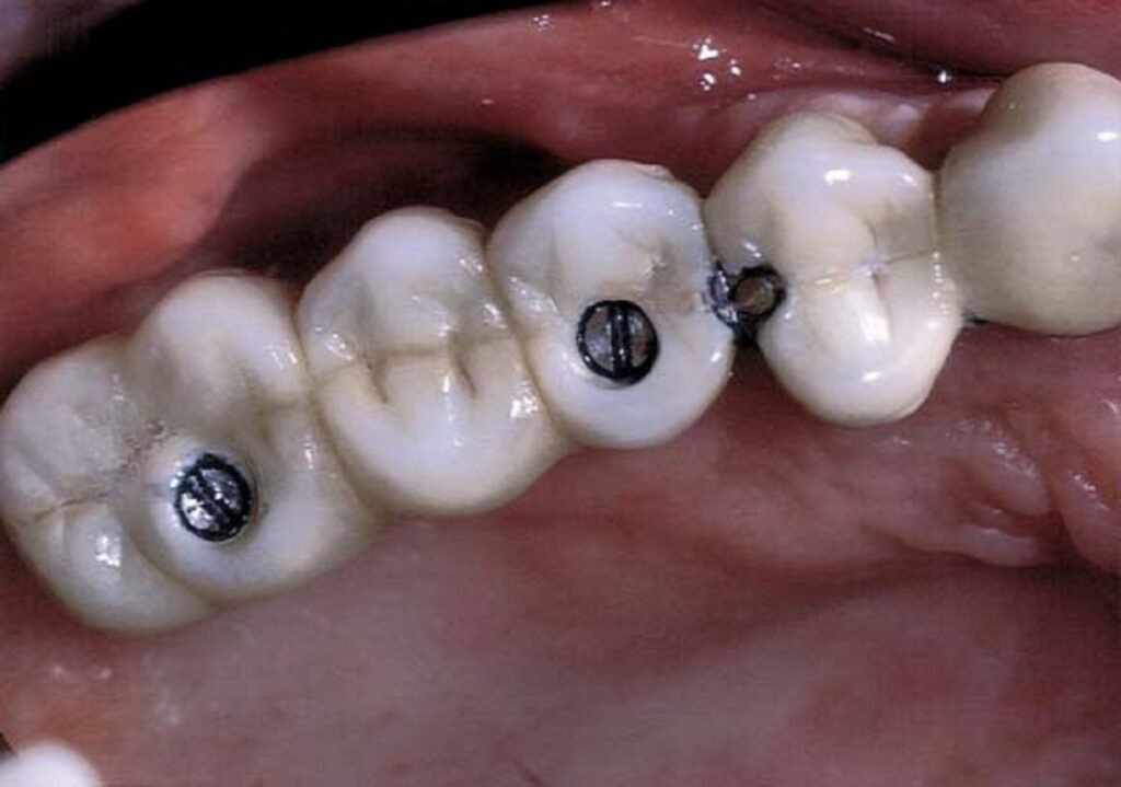 Splinted dental crowns