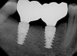 Splinted dental crowns