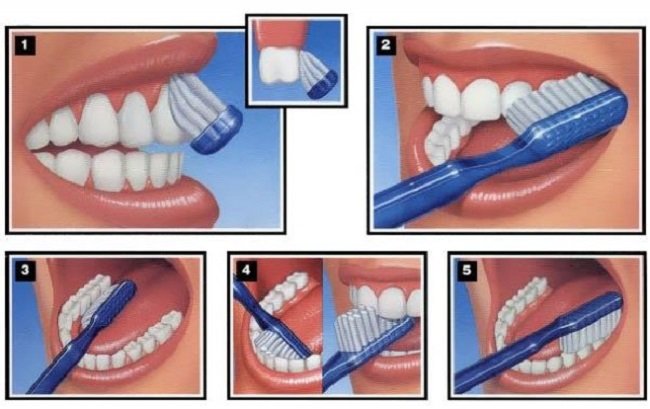 Steps for Brushing with the Right Technique
