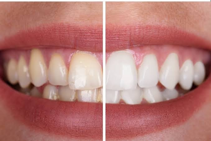 Teeth Whitening with Carbamide Peroxide 