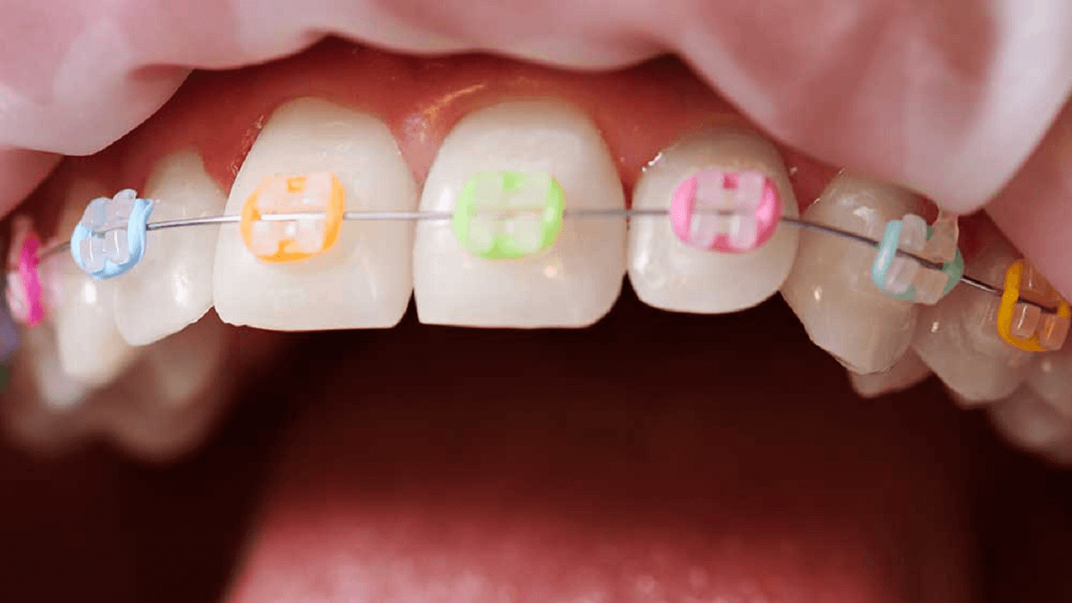 Teeth with braces with vibrant bands