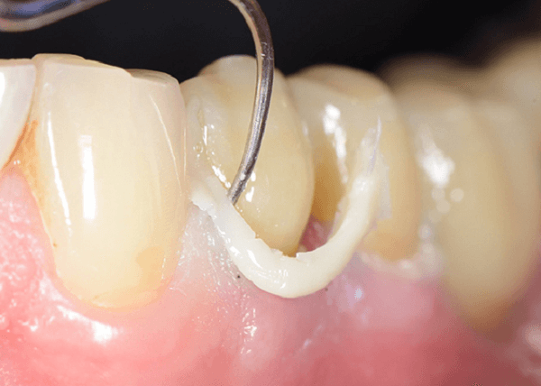 Temporary Adhesives