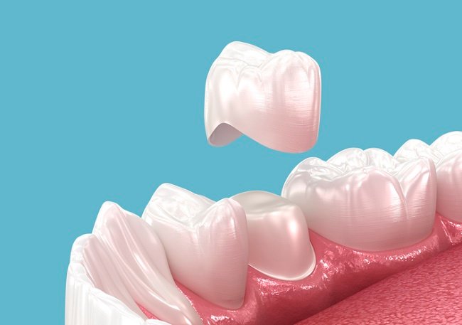 Temporary crowns