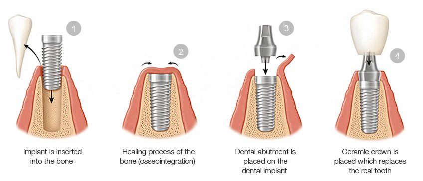 The Process of Same Day Dental Implants