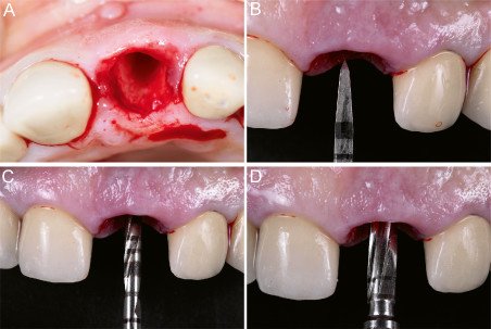 The Surgical Procedure to Place the Implants