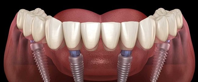 The benefits of the dental implant color chart