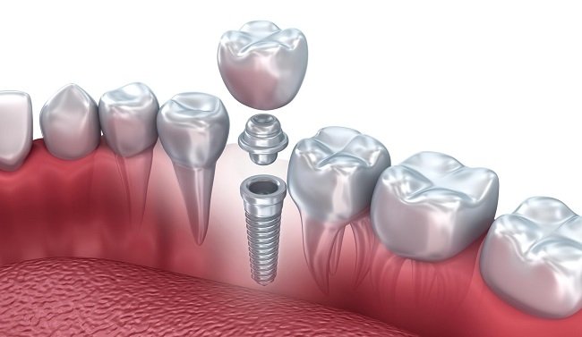 The dental implant procedure