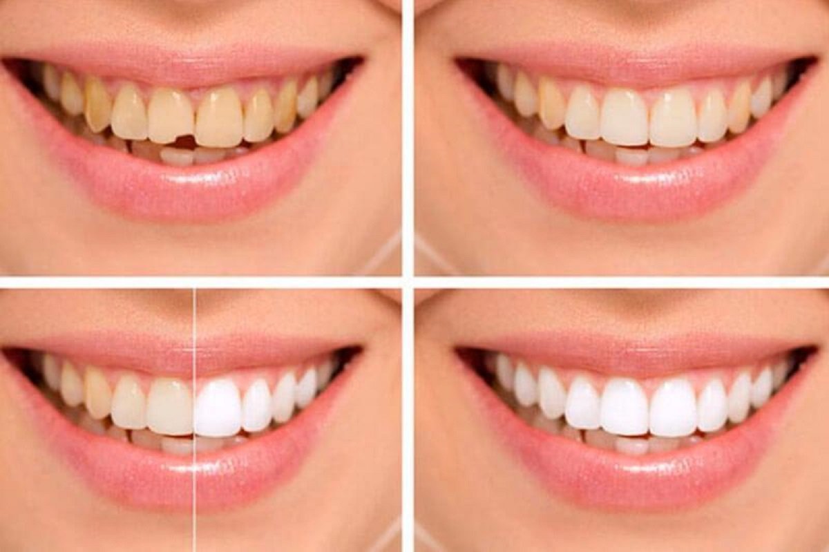 The image shows before and after comparison of dental cosmetic bonding procedure