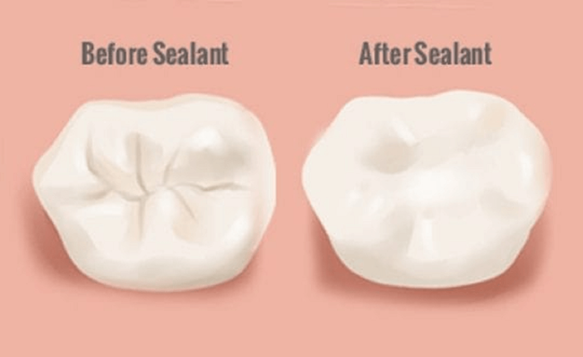 The image shows before and after results of a dental sealant on the teeth surface