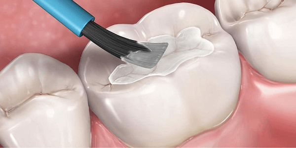 The image shows the application of liquid sealant material on tooth surface with the help of a brush