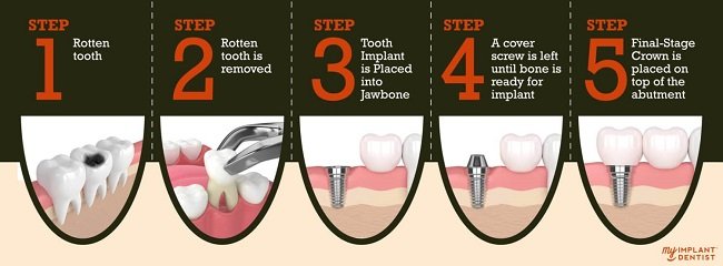 Tooth Extraction & Implant steps