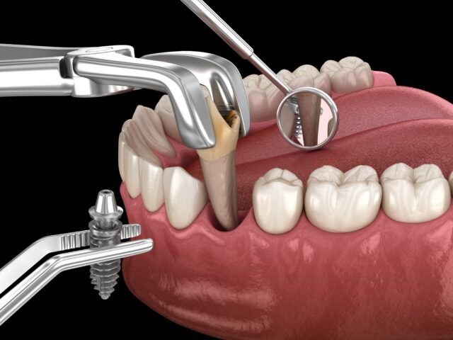 Tooth Extraction for implant