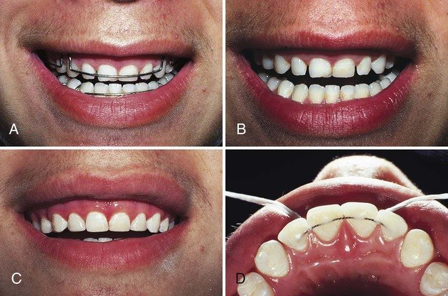 Tooth Preparation for splinted dental crown
