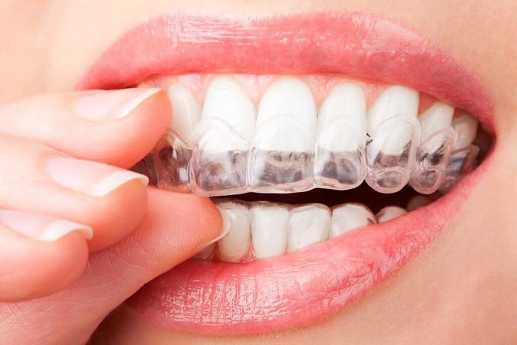Transparent Orthodontic Braces
