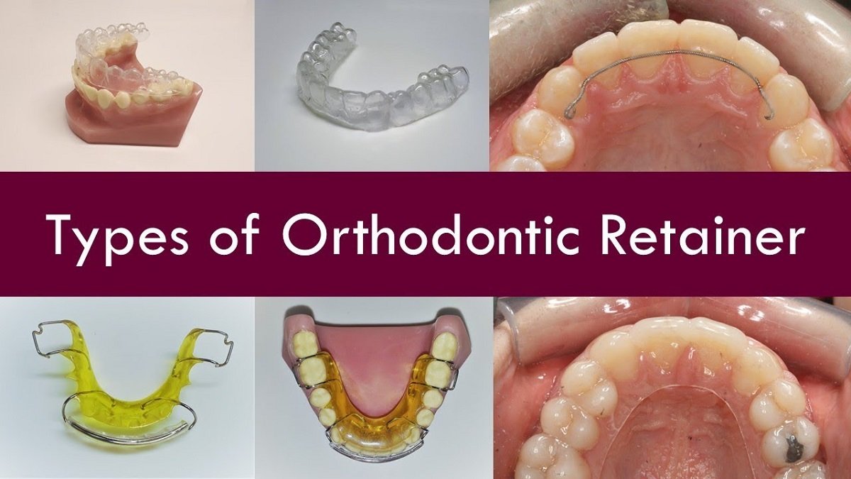 Understanding Orthodontic Retainer Types: A Complete Guide