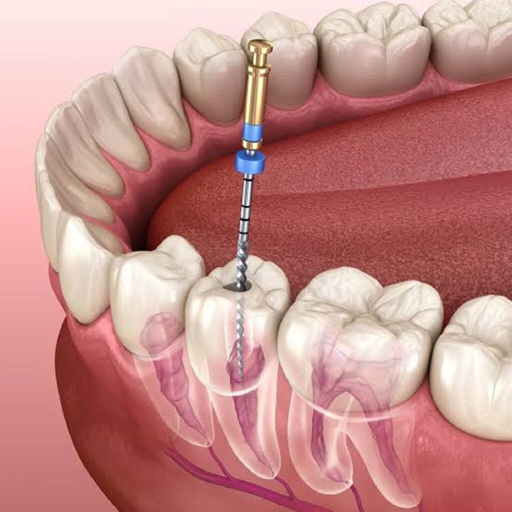 Visual Representation Of Treating Root Canal