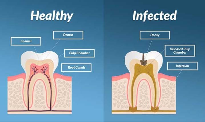 Visual comparison between infected & healthy teeth