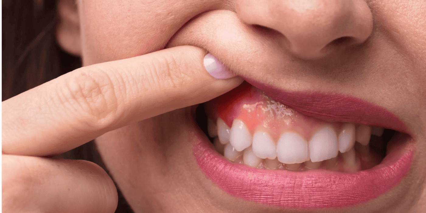 Visual representation of inflamed or infected gum, with visible redness