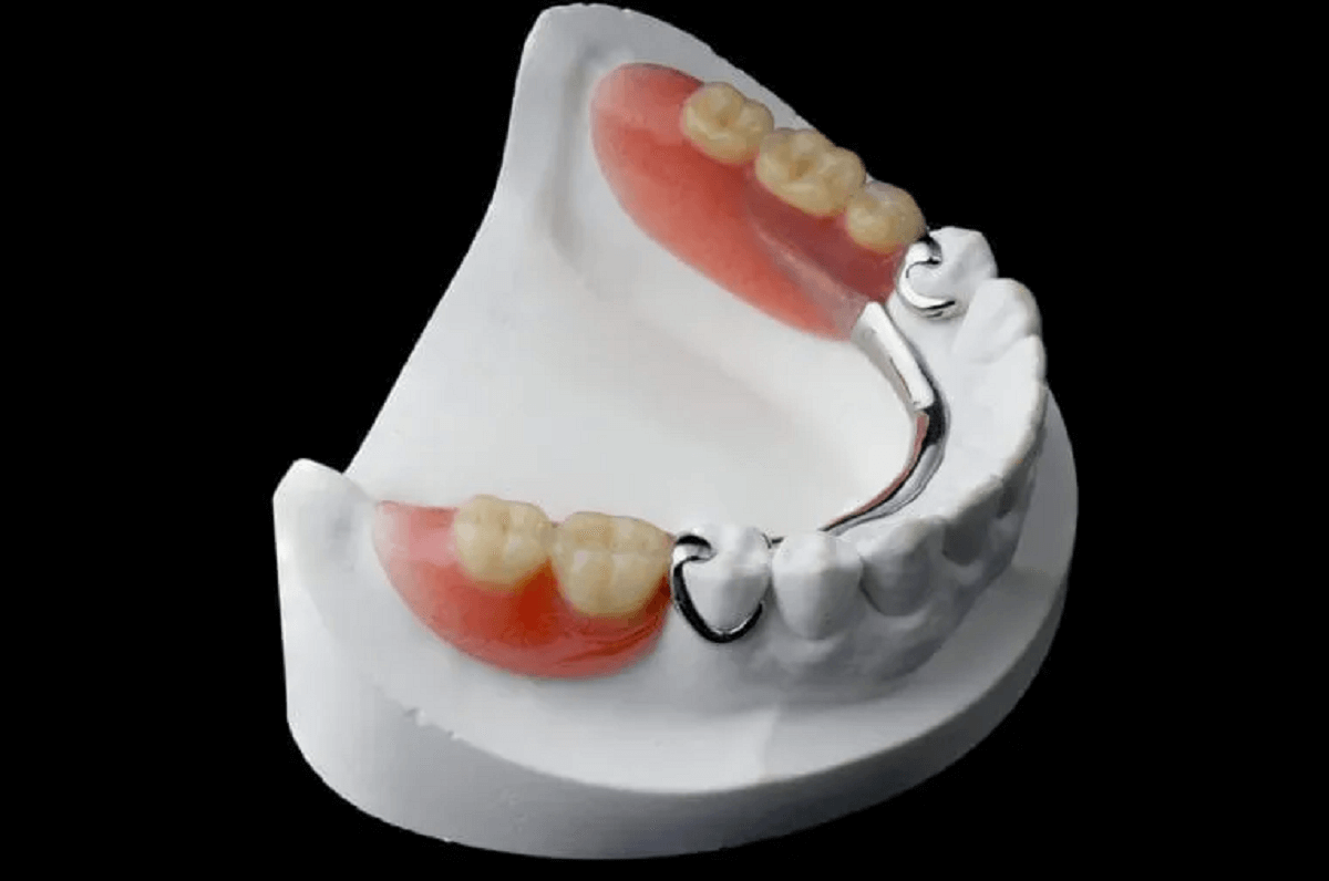 Visual representation of partial adhesive dentures