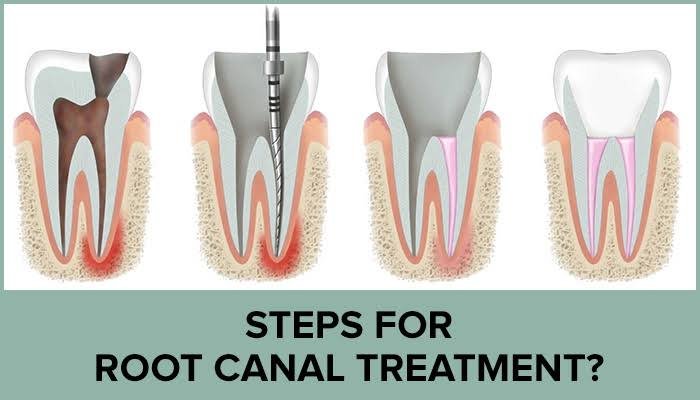 Visual representation of root canal procedure