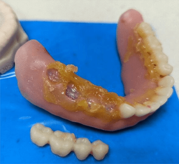 Wax try-in dentures