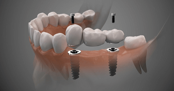 What Are Digital Dental Implants