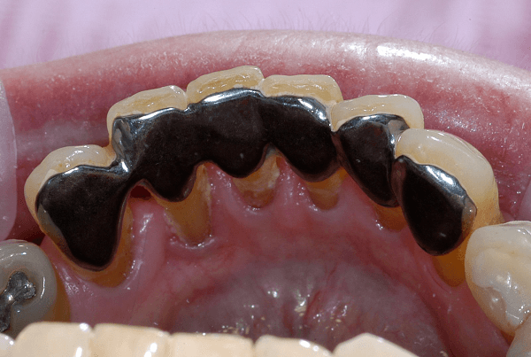What Is a Dental Bridge Adhesive