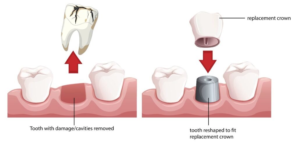 What are 3D-printed dental crowns