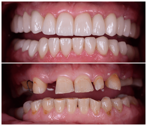 What to Expect with Immediate Dentures?